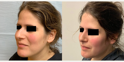 Woman treated with Rhinoplasty - Rhinoplasty