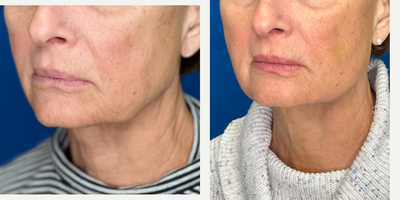 65-74 year old woman treated with Contour Thread Lift, Endolift, Nonsurgical Facelift, Nonsurgical Neck Lift - Non-Surgical Face and Neck Lift using Endolift Laser in combination with PDO Threads. The Endolift tightens lax skin, stimulates your skin collagen for a vibrant skin tone and contours unwanted fat. In combination with the PDO Threads that reposition fallen tissue and also stimulates collagen. Both procedures are outpatient with minimal discomfort or downtime. The entire procedure is done through tiny pin holes so there is no surgical scars. A natural revitalization and rejuvenation.