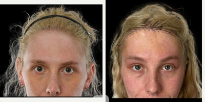25-34 year old transgender woman treated with Brow Lift, Facial Feminization Surgery, Forehead Reduction, Transgender Facial Fem - Facial feminization surgery including a Type 3 forehead reconstruction (brow bone reduction with setback), combined with a brow lift and orbital rim shaving to soften the upper face, open the eye area, and create a smoother, more feminine forehead and brow contour.Photos show the result after healing; individual results and recovery times may vary.