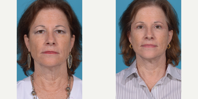 55-64 year old woman treated with Deep Plane Facelift, Eyelid Surgery, Facelift, Facial Fat Transfer, Lower Facelift, Mini Facel - Before and After Deep Plane SMAS face/neck lift with upper blepharoplasty