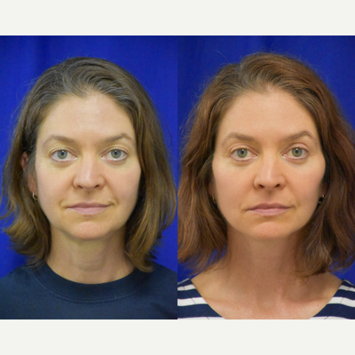 3489 45-54 year old woman treated with Facelift, Neck Lift, Facial Fat Transfer, Eyelid Surgery - 45-54 year old woman treated with Facelift, Neck Lift, Facial Fat Transfer, Eyelid Surgery