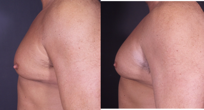 45-54 year old man treated with Nipple Surgery - Patient underwent bilateral nipple reduction under local anesthesia.
