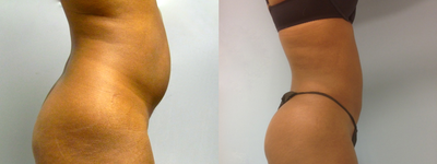 37 Year Old Female treated for abdominal contouring  - Liposuction of abdomen, flanks and lower back. Results at 4 months.