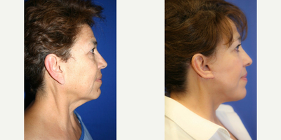 55-64 year old woman treated with Eyelid Surgery - This is 61 year old female. She was not happy with the appearance of her face or neck. She underwent a face lift, neck lift, brow lift, upper and lower blepharoplasty and earlobe reduction. - Individual Results May Vary