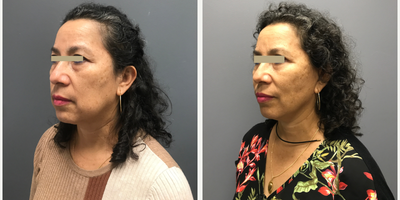 Woman treated with Facelift, Neck Lift - Woman treated with Facelift, Neck Lift