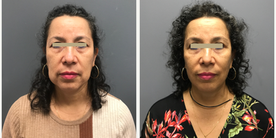 Woman treated with Facelift, Neck Lift - Woman treated with Facelift, Neck Lift