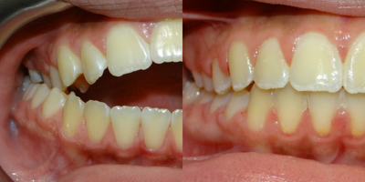 17 or under year old woman treated with Clear Braces - Dental Problems: Class I Malocclusion. Anterior Open Bite. Thumb Sucking Habit. Open Bite result of the habit.

Plan: Comprehensive Orthodontic Treatment with Fixed Appliances. Habit Breaking Appliance was used to help the patient to stop the habit. Non Extraction treatment.

Results: Bite closure occurred in 12 months time. Upper and Lower fixed Permanent retainers were used. Patient is placed on 2 years retention follow up.