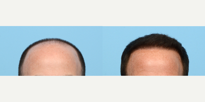 45-54 year old man treated with FUE Hair Transplant, Hair Transplant, Hair Loss Treatment, PRP for Hair Loss - This 48-year-old patient wanted to rebuild his hairline and add density. Dr. Wise performed an FUE hair transplant with 3,320 grafts and one treatment of PRP to achieve these goals. One year post-op the patient is thrilled with his results!