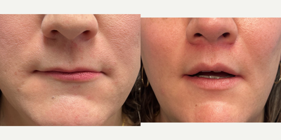 35-44 year old woman treated with Lip Lift, Lip Surgery - this is a young women who underwent lip surgery with lip lift and augmentation.
