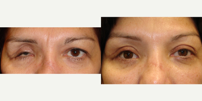 Woman treated with prosthetic eye - This woman was involved in a car accident with severe damage to the right eye. She also sustained damage to the eyelids. As you can see the injury led to disfigurement. She was a very active and happy person who was devastated by what happened to her. She underwent two surgeries. The first  was reconstructive with fitting of a prosthesis. The next was cosmetic to improve the lids. While her final appearance (bottom right) is not perfect, it is certainly much improved.&nbsp;