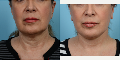 55-64 year old woman treated with Mini Lift - Combined Precision TX Laser and Modified Face/Neck Lift