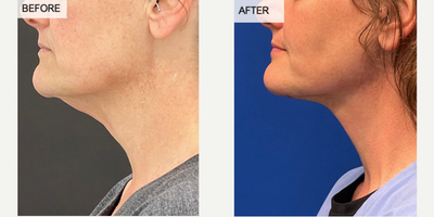 45-54 year old woman treated with Neck Lift - This patient underwent neck lift surgery to remove excess skin to improve the shape and contours of her neck.