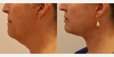 Neck Slim Laser Liposuction - Patient wanted to remove excess hanging fat from their neck and opted to do neck liposuction with slim laser. Patient is very happy with their slimmer side profile and natural results.