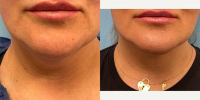 45-54 year old woman treated with ThermiTight - 45 year old female underwent a ThermiTight procedure under Local Anesthesia.