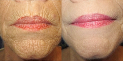 55-64 year old woman treated with Fat Transfer and Fractional CO2 Laser Skin Resurfacing - This patient came to see me regarding the deep lines around her mouth.  Once I came to understand her goals and expectations, I created a treatment plan for her which included fat transfer around the mouth to treat the indented lines and loss of volume. On the same day, I then performed fractional CO2 laser skin resurfacing to the skin around her mouth to achieve a smoother yet natural appearance. Recovery time took about 7-10 days.
