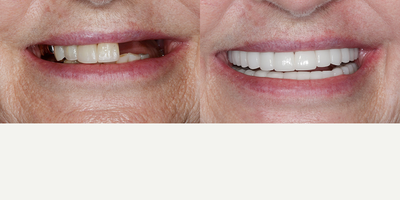 Dental Implants, Implant-Supported Crowns, Porcelain Crowns, and Porcelain Veneers - This patient came to Dr. Lewis wanting to restore her implants and improve the overall appearance of her smile. He evaluated her x-rays and discussed her treatment options. She wanted to have her whole mouth redone. They decided to redo most of her implants as well as the dental bridge she had on teeth #10-#12. Her bottom front teeth are now porcelain veneers, and the rest of her teeth are now porcelain crowns or implant-supported crowns. This was a huge transformation for our patient and she is so incredibly happy with her new smile!