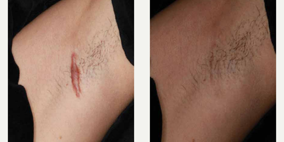 Man treated with ResurFX - Photo provided courtesy of Lumenis, Ltd., performed by Matteo Tretti Clementoni, MD