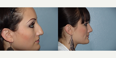 18-24 year old woman treated with Rhinoplasty - Weight: Between 100 and 115 Height: 5'4 to 5'7