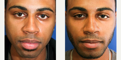 25-34 year old man treated with Lip Reduction - A 26-year-old Miami cosmetic surgery patient came to our plastic surgery clinic in Fort Lauderdale requesting improvement of his chin and lips. He wanted more square, masculine chin and mild reduction of his lips. Clinical evaluation revealed a small, narrow chin positioned far behind his protruding lips and nose on profile view. He also demonstrated narrow chin which was over-shadowed by large lips on front view (left). Surgery was performed in our AAAA Certified Office Surgery Center in Fort Lauderdale in general anesthesia. It included placement of a large chin implant through a small incision placed inside of the mouth as well as reduction of upper and lower lips. Pre-operative images on the (left); after lip surgery and chin enlargement with silicone implant on the right. Notice increase in chin projection and size on profile view and strong, masculine, square chin and proportionally smaller lips. This gives much more balance and harmony to his entire face.