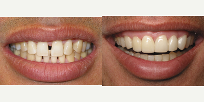 45-54 year old man treated with Lumineers - Lumineers is great for spaces since there are no removal of tooth structures.