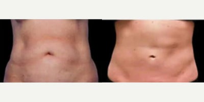 Woman treated with CoolSculpting - Woman treated with CoolSculpting. Patient is shown before and 12 weeks after second treatment.