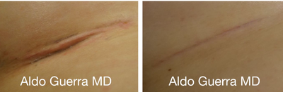 25-34 year old woman treated with Embrace Scar Therapy - Breast augmentation with MemoryShape breast implants under the breast crease incisions. Close up photo of the incisions treated with embrace Active Scar Defence shown at 4 months.