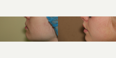 25-34 year old woman treated with Lip Lift - lip lift