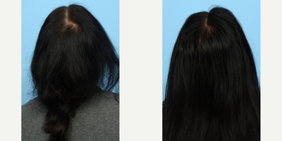 35-44 year old woman treated with PRP for Hair Loss, Hair Loss Treatment, HydraFacial - This patient underwent 3 sessions of PRP therapy for hair loss with Dr. Wise. Three months after her third session, she has susbtanial growth and more density to her hair.