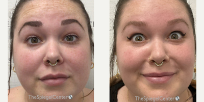 25-34 year old woman treated with Xeomin - botulinum