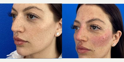 25-34 year old woman treated with Nonsurgical Nose Job - Fillers used to enhance the nose