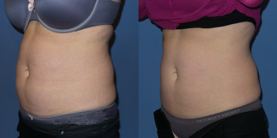 38 y/o female who was treated with SculpSure to her abdomen and flanks. - 38 y/o female who was treated with SculpSure to her abdomen and flanks.  She is shown 6 weeks after treatment.