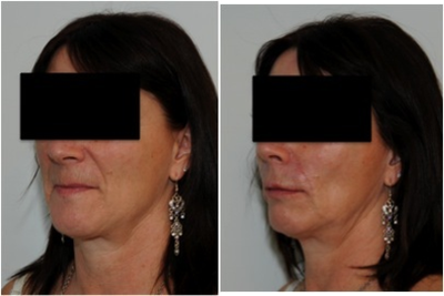 Evolence Smile Lines - Patient had Evolence injected in her nasolabial creases (smile lines). She is shown before and immediately after. Notice the smoothness of the lines after the injection.