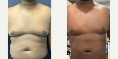 45-54 year old man treated with Breast Reduction - 45-54 year old man treated with Breast Reduction
