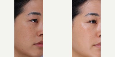 35-44 year old woman treated with BroadBand Light (BBL), Microneedling RF - 3 weeks after 1 session of BBL and RF Microneedling.