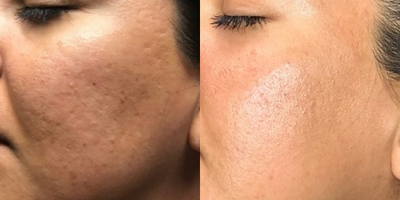 25-34 year old woman treated with Lux 1540 - This is after 6 treatments of LUX 1540.