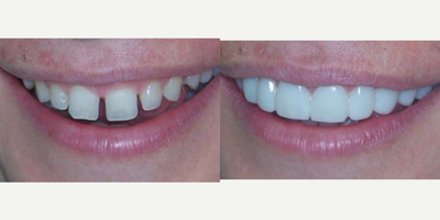 25-34 year old woman treated with Snap-On Smile - Before and after snap on smile