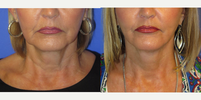 63 year old woman treated with Lower Face Lift - 63 year old female who was developing jowls and a loose neck. She had a FACEOLOGY LIFT (Lower Face and Neck Lift). Note, the smoother contour of the jawline and lifted neck line.