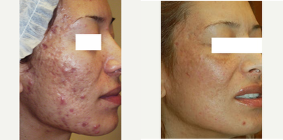 35-44 year old woman treated with Acne Scars Treatment - Patient had several treatments.