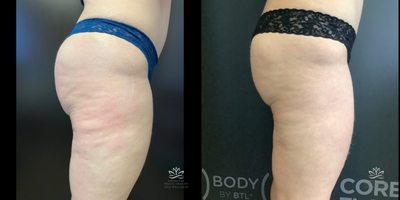 35-44 year old woman treated with Emtone - 42 year old woman works out daily - wanted to optimize her bodyThis is 4 Emtone for cellulite- 3 months - and 4 more Emtone (weekly)