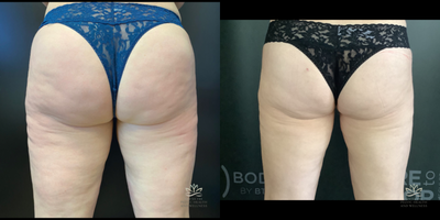 35-44 year old woman treated with Emtone - 42 year old woman works out daily - wanted to optimize her bodyThis is 4 Emtone for cellulite- 3 months - and 4 more Emtone (weekly)
