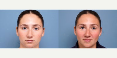 25-34 year old woman treated with Cheek Fillers - 25 year old woman treated with Cheek Fillers. Photos depict before and 2 weeks after 2 syringes of rha4 to jawline