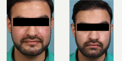 18-24 year old man treated with Microneedling and PRP - 18-24 year old man treated with Microneedling and PRP for scarring on cheeks.