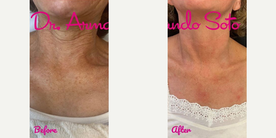 Woman treated with Moxi - This patient who is shown before and 1 month after only ONE Moxi treatment. Her results will only improve with time and subsequent treatments, but you can already see that her brown spots have improved and her overall skin tone is brighter and smoother.