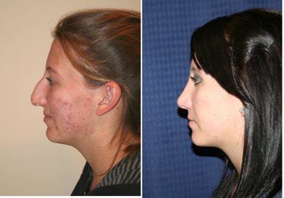 Rhinoplasty - 
	Rhinoplasty
