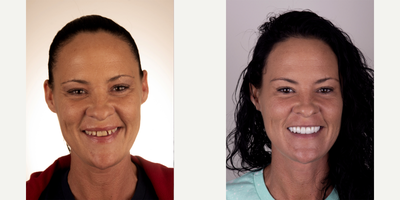 35-44 year old woman treated with Implant, Dysport, Facial, and Porcelain Restorations - Patient did not like her teeth, and gap where had a tooth pulled over a year ago. She wanted a beautiful smile that she could be proud of. Dr. Cha placed an implant where the missing tooth was. While patient's implant was healing, Dr. Cha placed a trial smile in acrylic, so patient would be able to confidently smile. Once proper alignment of where the jaws, teeth and muscles was achieved, along with patient loving her new smile, Dr Cha prepped the teeth for porcelain restorations. Dr. Cha also utilized Dysport to smooth the wrinkles. Dr. Cha then performed a mini facial with the Fotona Laser for skin resurfacing and micro-needling. Patient now feels more confident, and beautiful with the smile she wanted her whole life.