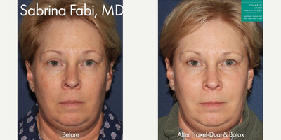 Woman treated with Fraxel Laser - Woman treated with Fraxel Laser