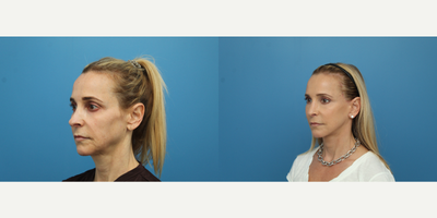 45-54 year old woman treated with Facial Fat Transfer - This patient came in wanting a fresher look. Dr. Balikian performed procedures for facial rejuvenation including a Facelift, Rhinoplasty and Fat Transfer to treat all areas of facial aging. The patient is thrilled to look like herself, look refreshed and breathe better.
