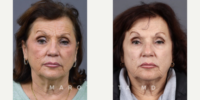 Woman treated with Laser Resurfacing, CO2 Laser - This patient chose to focus on her skin with CO2 laser resurfacing. This advanced treatment has visibly rejuvenated the skin, reducing signs of aging, sun damage, and enhancing overall texture and tone.