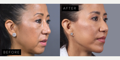 Woman treated with Eyelid Surgery, Deep Plane Facelift, Facial Fat Transfer, Lip Lift, Chin Implant - .- Blepharoplasty: Brightening and rejuvenating the eyes..- Deep Plane Mini Lift: Refining facial contours with elegance..- Fat Injections: Restoring youthful fullness and vitality..- Lip Lift: Perfectly enhancing the smile..- Chin Implant: Sculpting a harmonious, balanced profile.Surgery by Dr. James Marotta