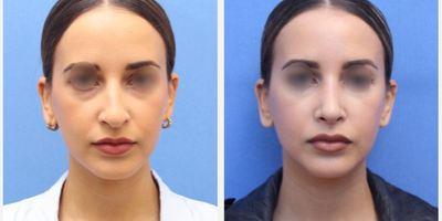 Woman treated with Nose Surgery - Woman treated with Nose Surgery